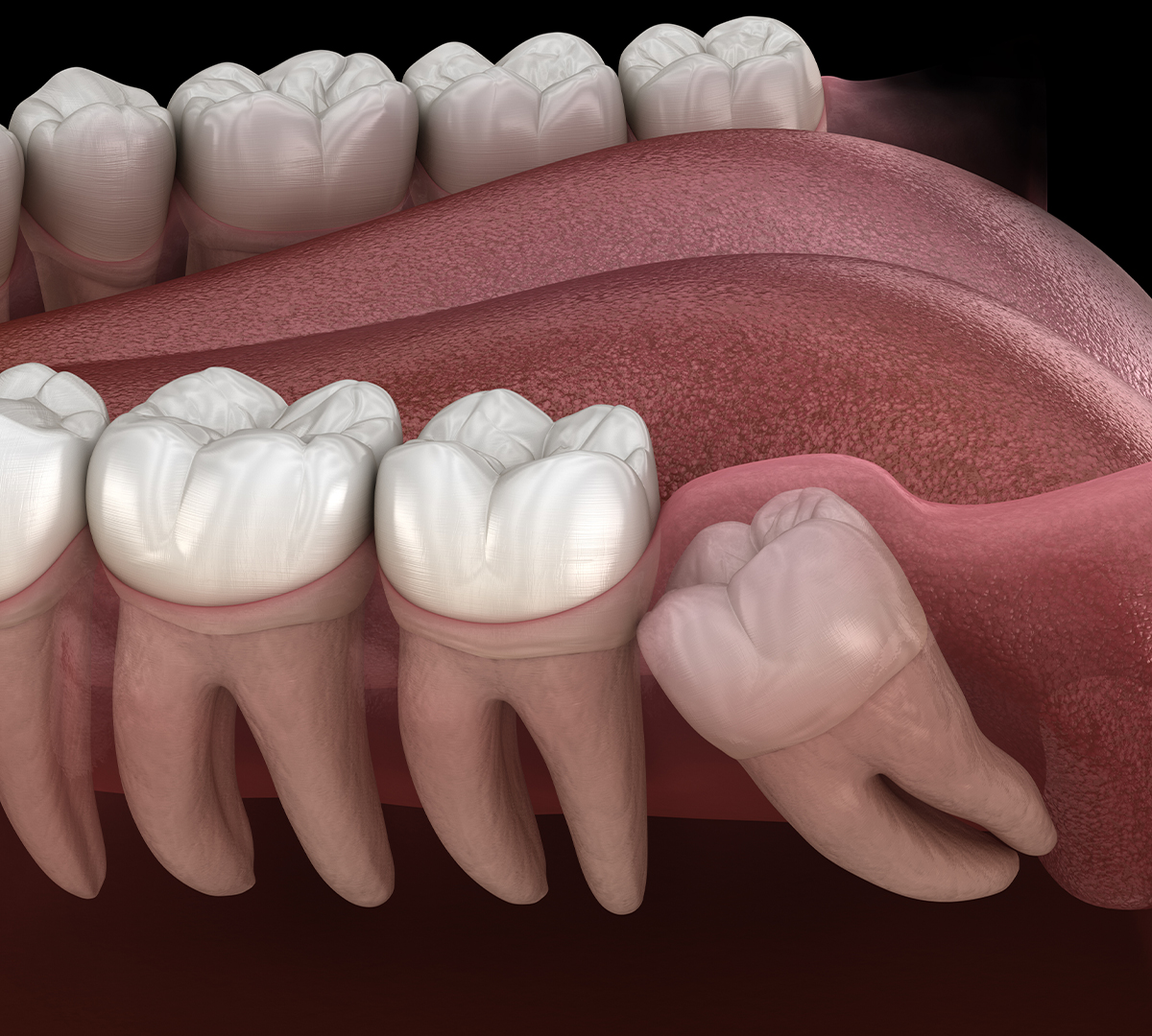 extraction-dent-de-sagesse-strasbourg