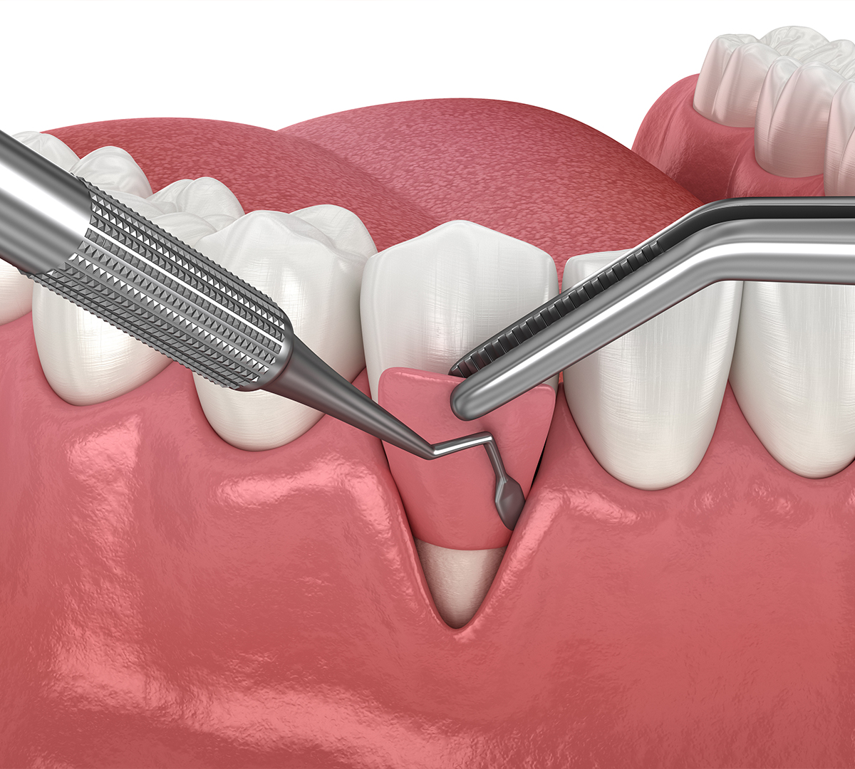 greffe-de-gencive-cabinet-dentaire-strasbourg
