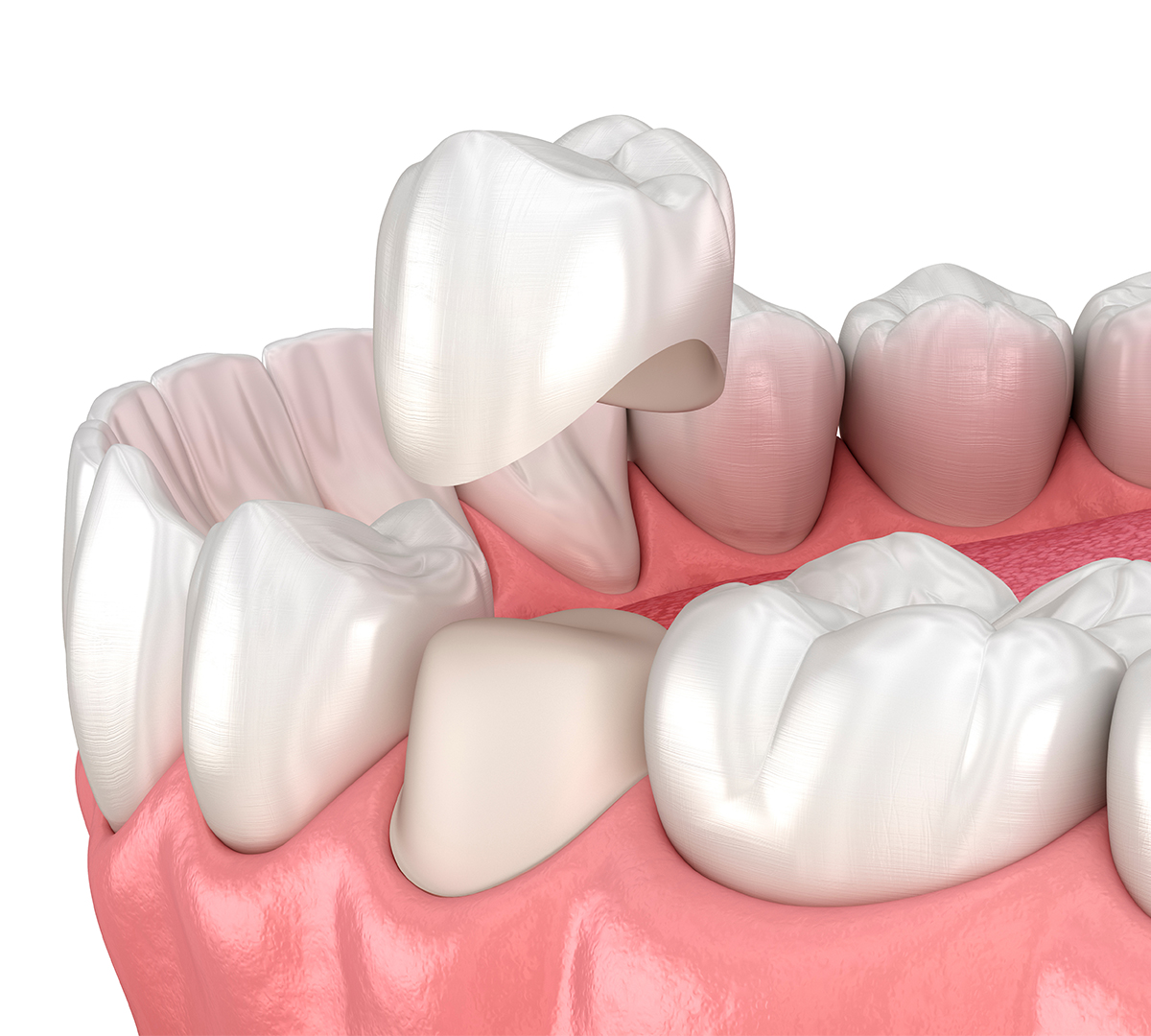 prothese-couronnes-cabinet-dentaire-strasbourg
