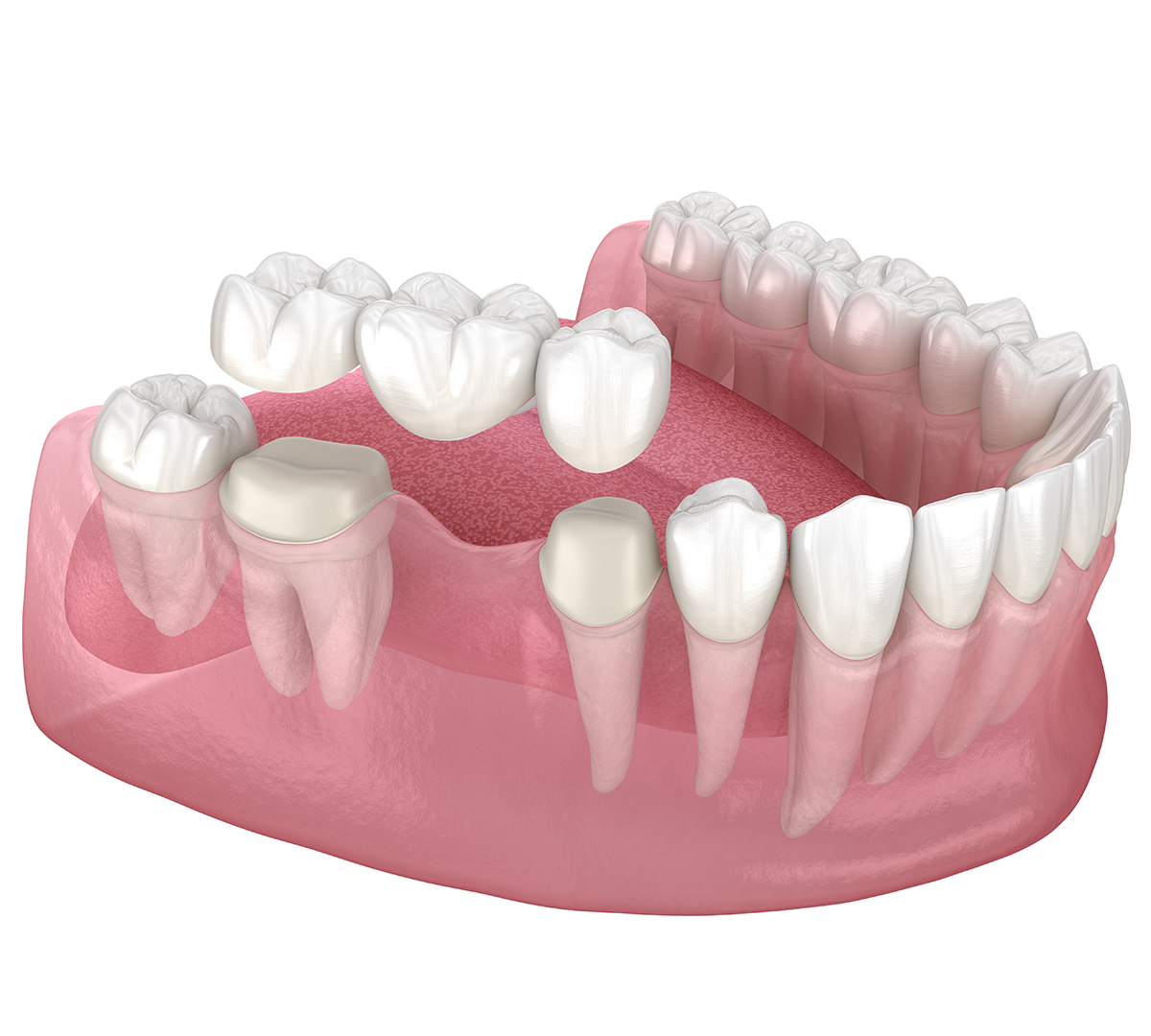 protheses-ponts-bridge-cabinet-dentaire-strasbourg